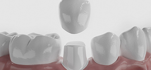 diagram of a dental crown