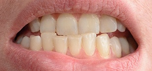 closeup of crowded teeth