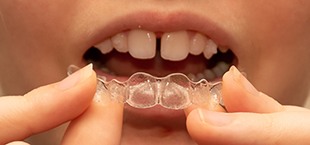 teen with gapped teeth putting in clear aligners