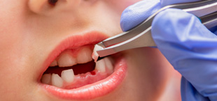 baby tooth being taken out of a child’s mouth