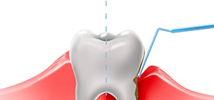 diagram showing the difference between healthy gums and gum disease 