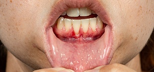 closeup of w child’s mouth with gum recession